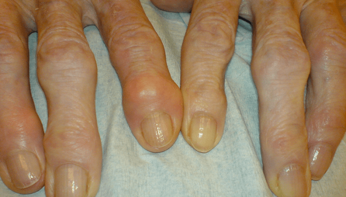 Sakit sa mga lutahan sa mga tudlo sa osteoarthritis
