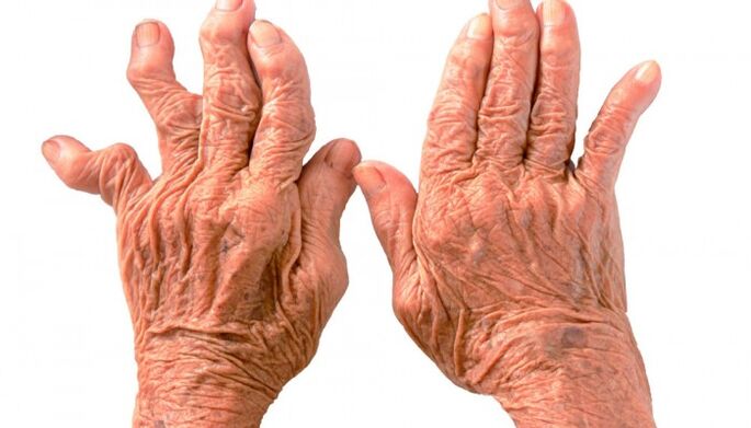 rheumatoid arthritis ingon usa ka hinungdan sa kasakit sa mga lutahan sa mga tudlo