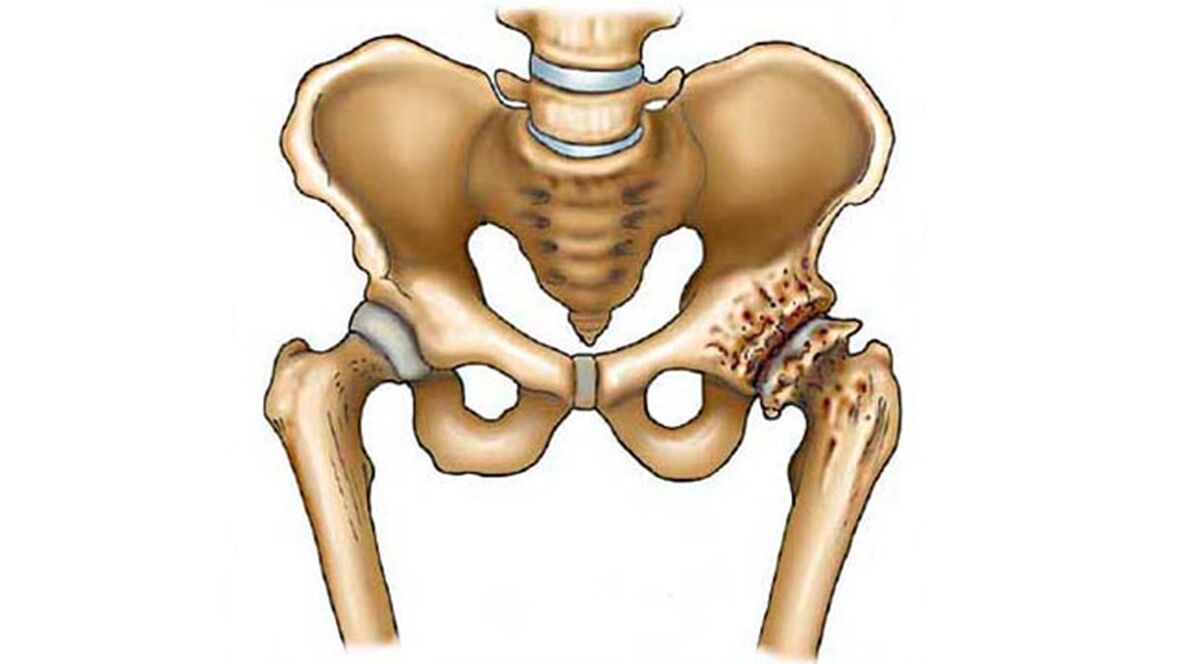 Ang kadaot sa hip joint sa presensya sa arthrosis