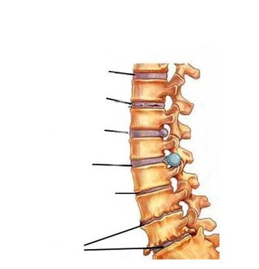 Mga yugto sa pag-uswag sa osteochondrosis