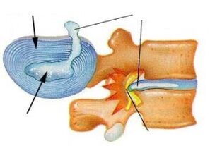 pagkaguba sa fibrous singsing sa cervical osteochondrosis