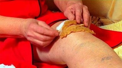 Ang mga compresses alang sa arthrosis sa lutahan sa tuhod