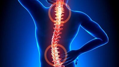 mekanismo sa pag-uswag sa osteochondrosis