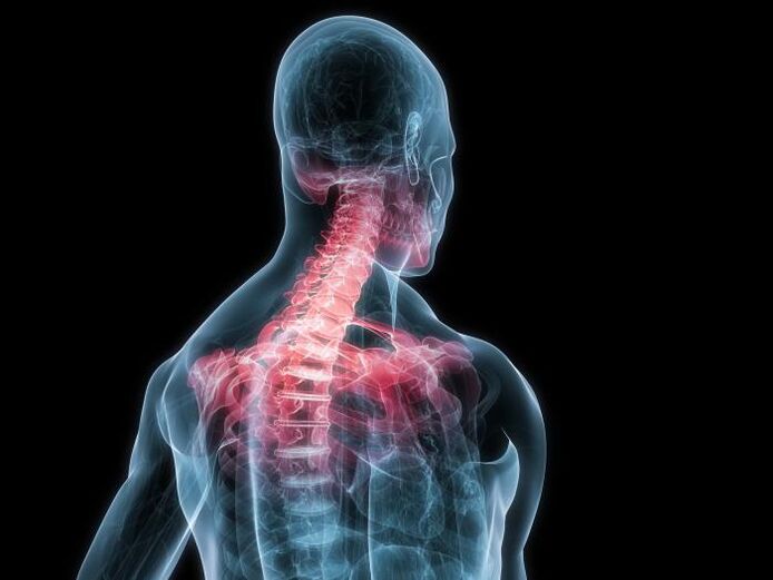 Ang osteochondrosis sa cervical spine usa ka pagbag-o sa mga intervertebral cartilaginous discs