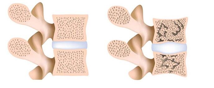 osteoporosis - ang pagkuha sa calcium gikan sa mga bukog