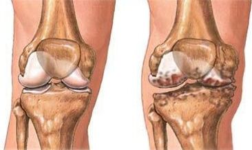 Arthrosis sa tuhod