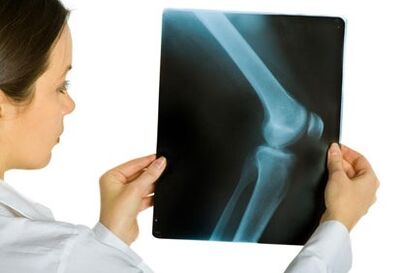Pagtambal sa arthrosis sa tuhod nga hiniusa