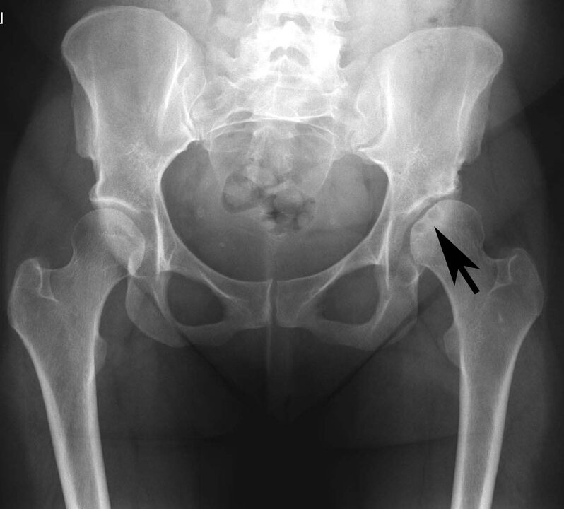 Deposition sa calcium salts sa hip joint nga adunay pseudogout sa x-ray