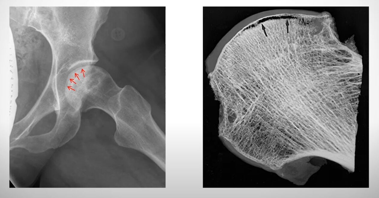 X-ray sa femoral ulo nga apektado sa aseptic necrosis